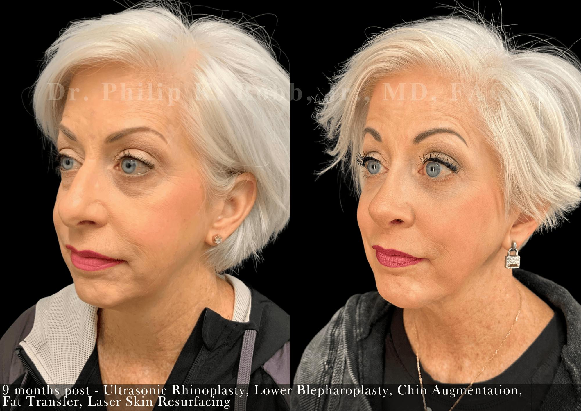 Lower Blepharoplasty Before & After Gallery - Patient 344283 - Image 4