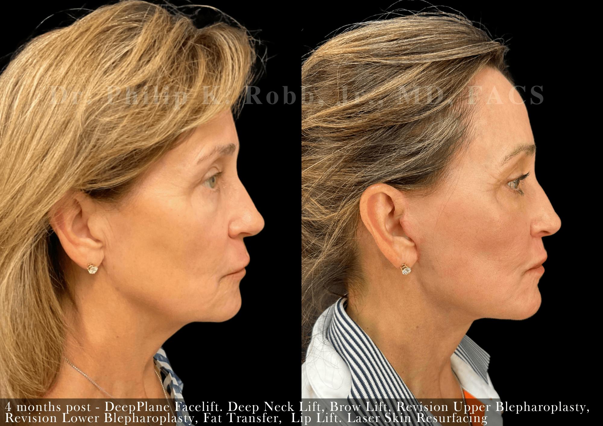 Facelift Before & After Gallery - Patient 416237 - Image 4