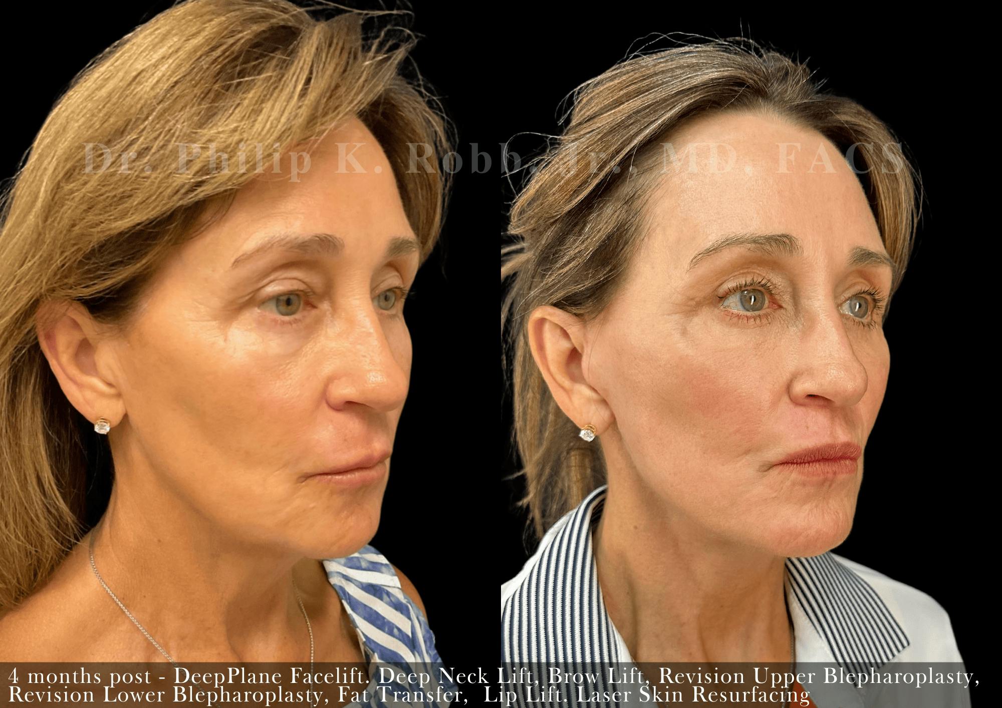 Facelift Before & After Gallery - Patient 416237 - Image 5