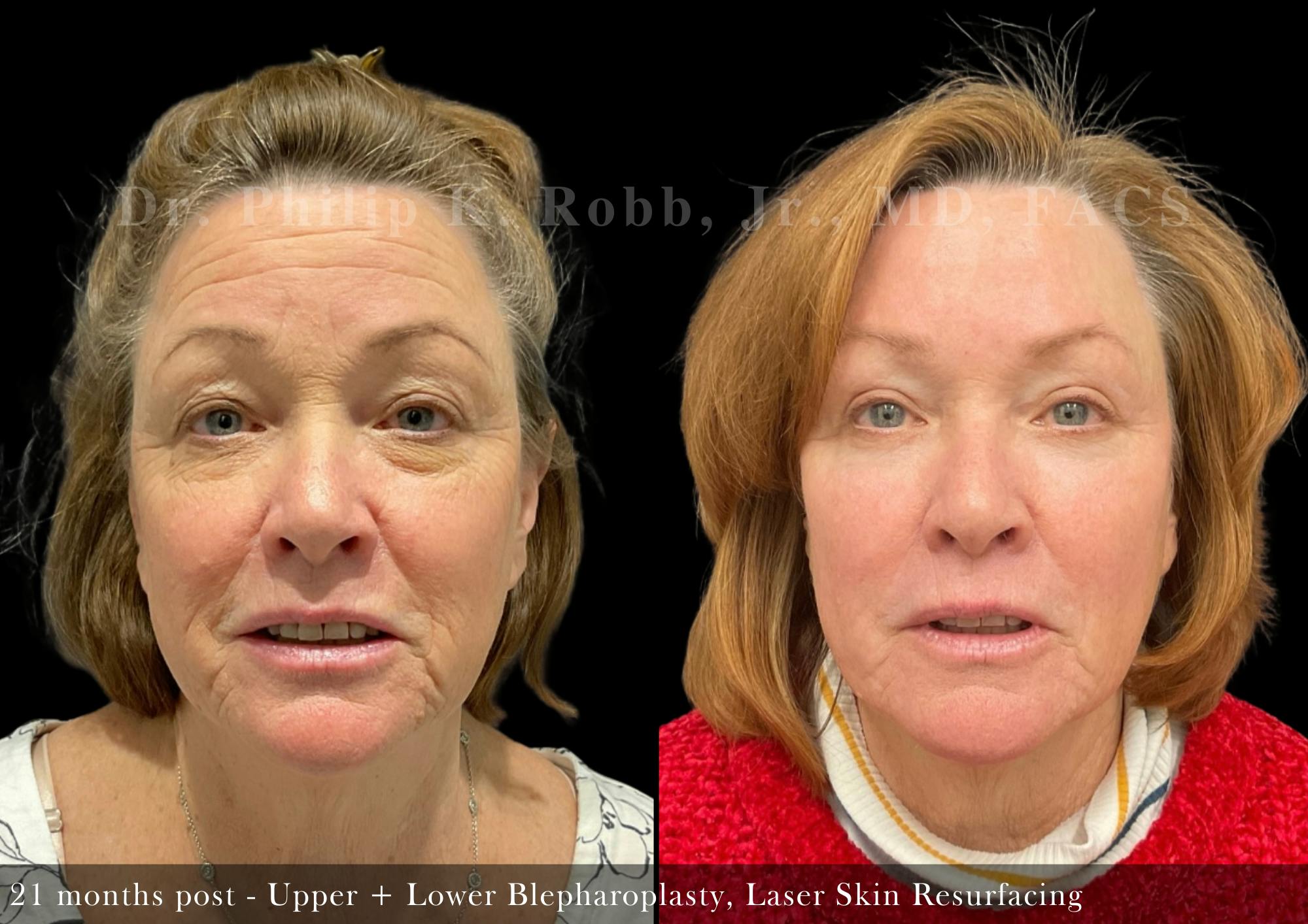Laser Skin Resurfacing Before & After Gallery - Patient 112786 - Image 1