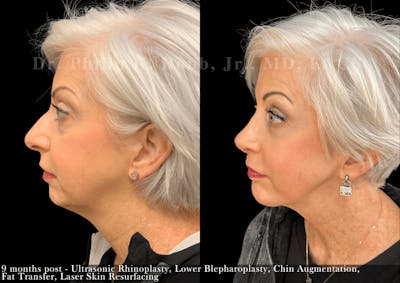 Chin Augmentation Before & After Gallery - Patient 786659 - Image 1