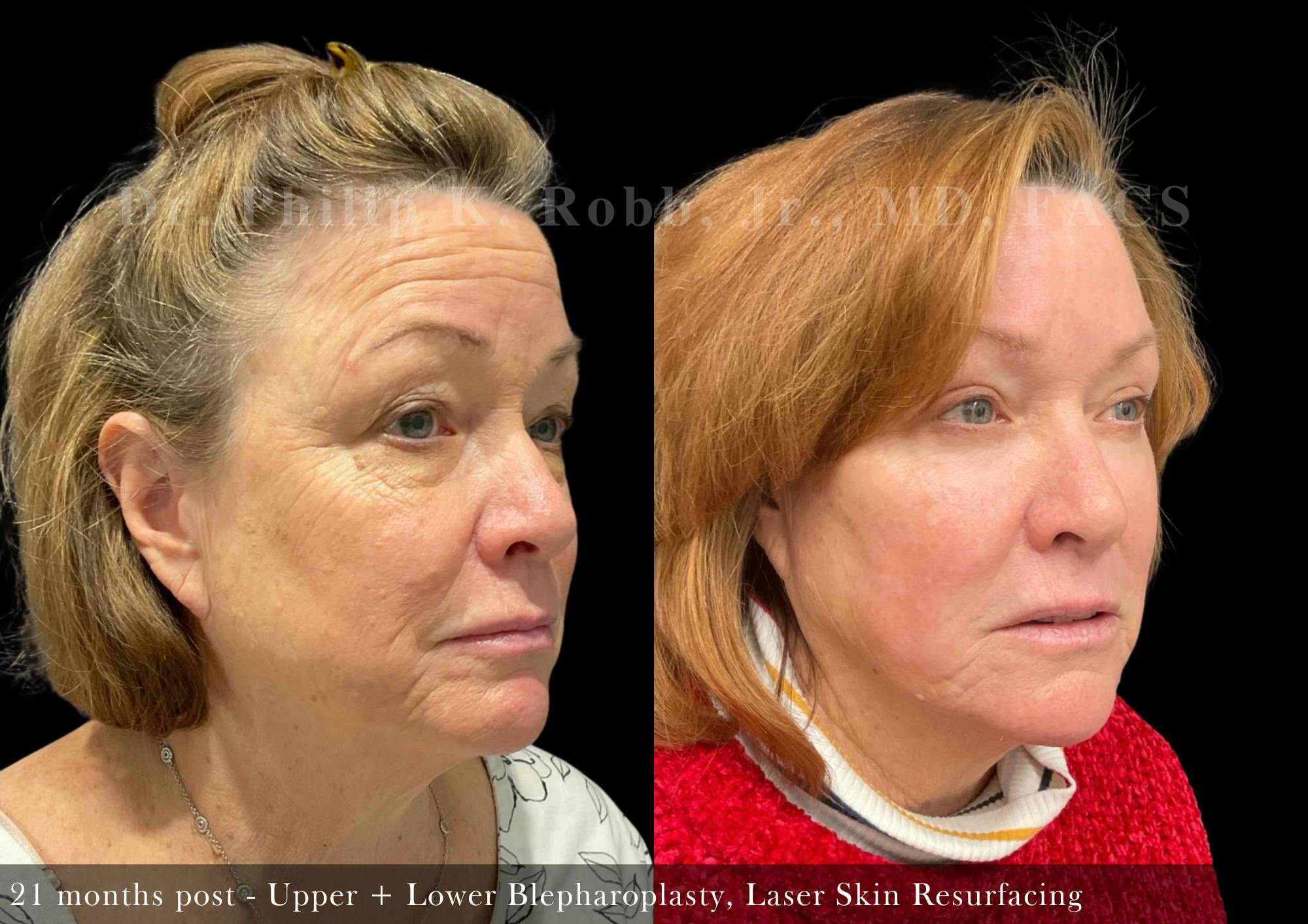 Laser Skin Resurfacing Before & After Gallery - Patient 112786 - Image 2