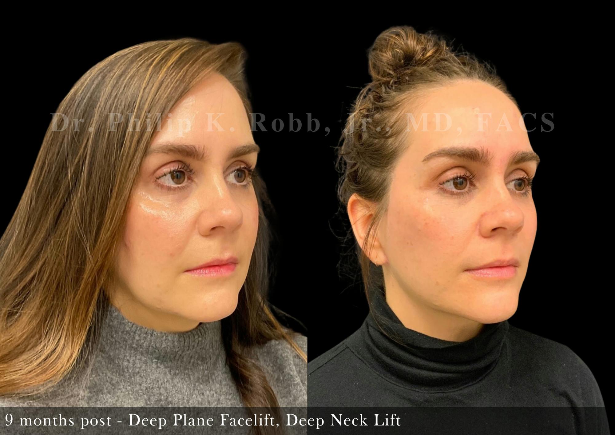 Facelift Before & After Gallery - Patient 296872 - Image 2