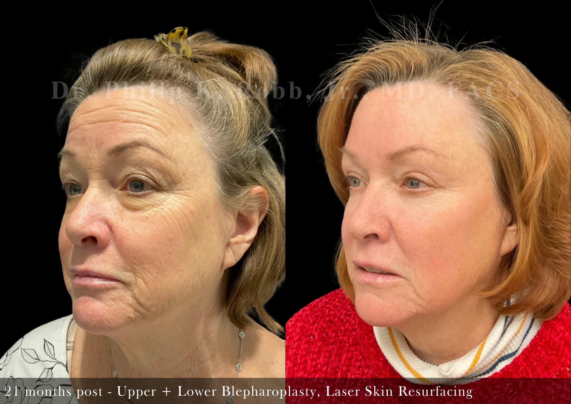 Laser Skin Resurfacing Before & After Gallery - Patient 112786 - Image 3