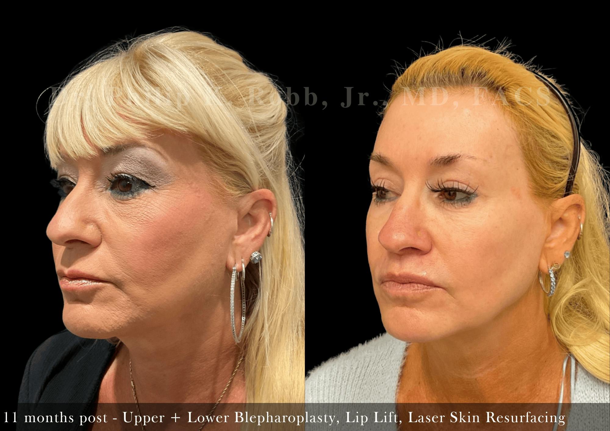 Lower Blepharoplasty Before & After Gallery - Patient 192642 - Image 2