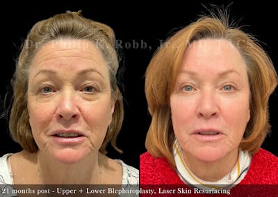 Upper Blepharoplasty Before & After Gallery - Patient 233492 - Image 1