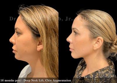 Chin Augmentation Before & After Gallery - Patient 148441 - Image 1