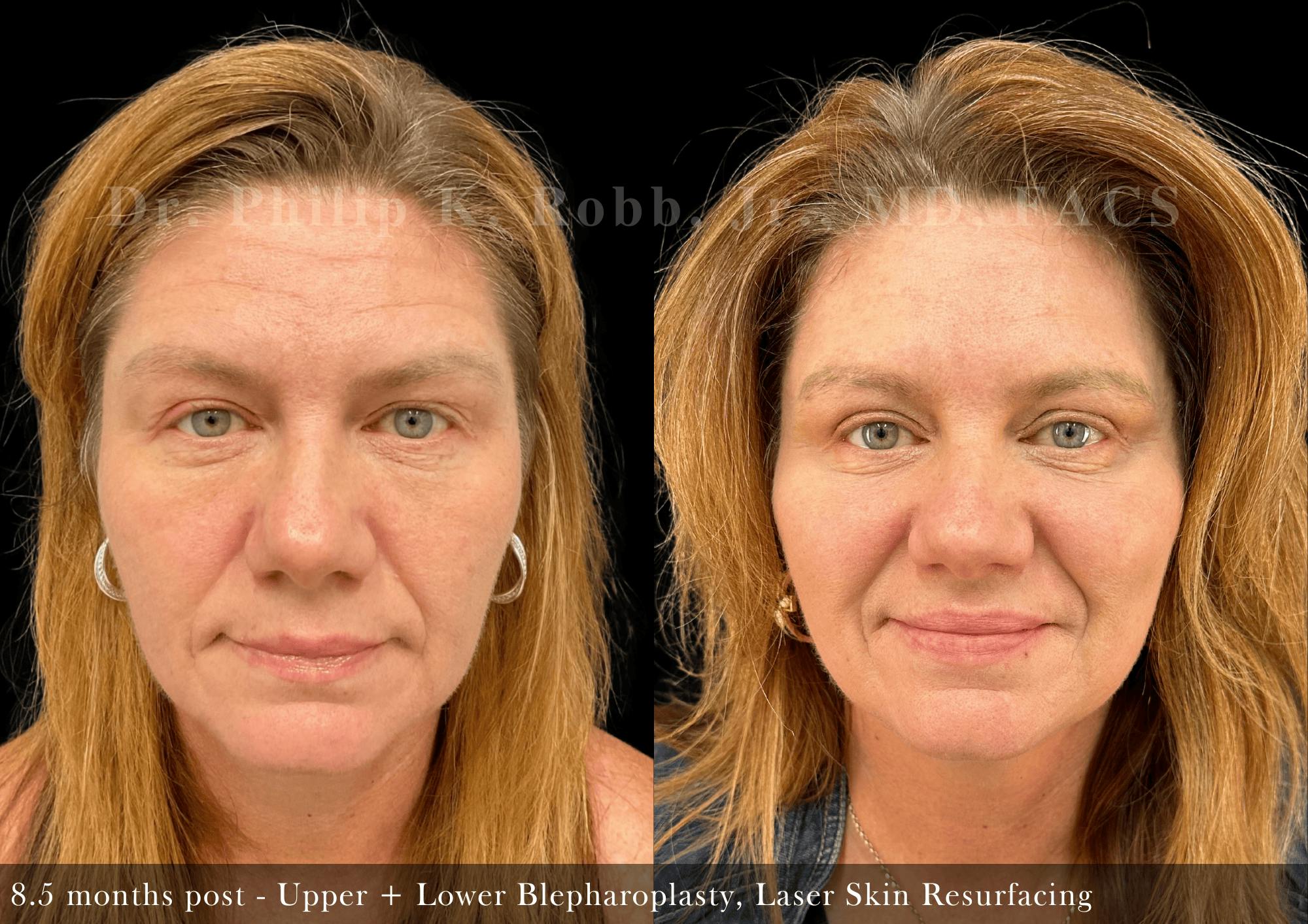 Lower Blepharoplasty Before & After Gallery - Patient 342990 - Image 1
