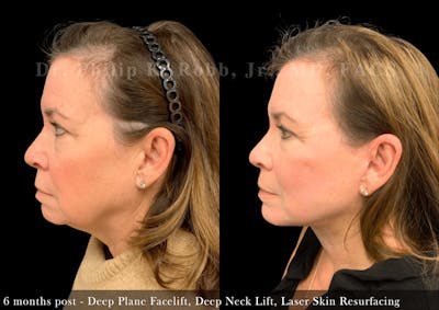 Neck Lift Before & After Gallery - Patient 279423 - Image 1