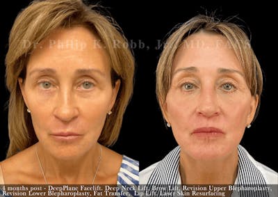 Fat Transfer Before & After Gallery - Patient 135015 - Image 1