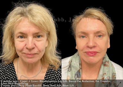 Upper Blepharoplasty Before & After Gallery - Patient 414961 - Image 1