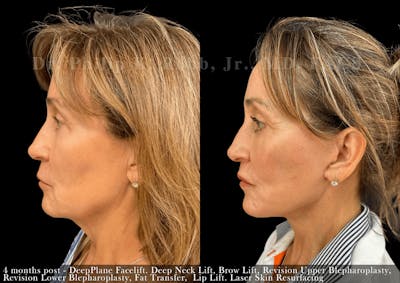 Neck Lift Before & After Gallery - Patient 312905 - Image 1