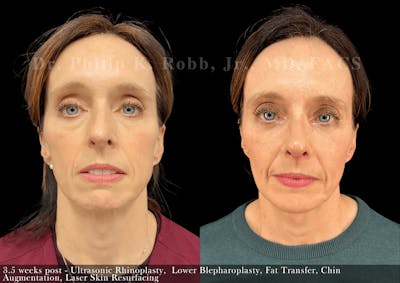 Chin Augmentation Before & After Gallery - Patient 116245 - Image 1