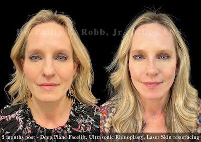 Facelift Before & After Gallery - Patient 710736 - Image 1