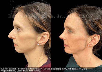 Chin Augmentation Before & After Gallery - Patient 116245 - Image 1