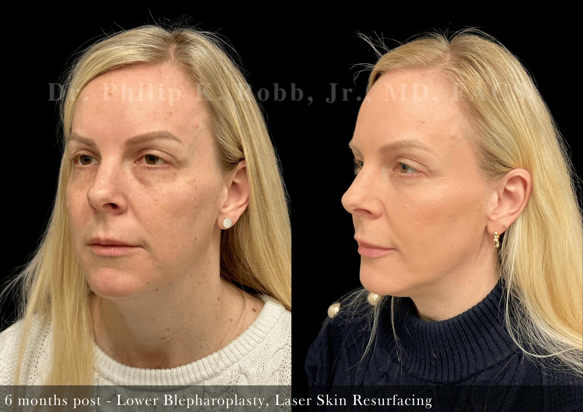 Lower Blepharoplasty Before & After Gallery - Patient 232066 - Image 2