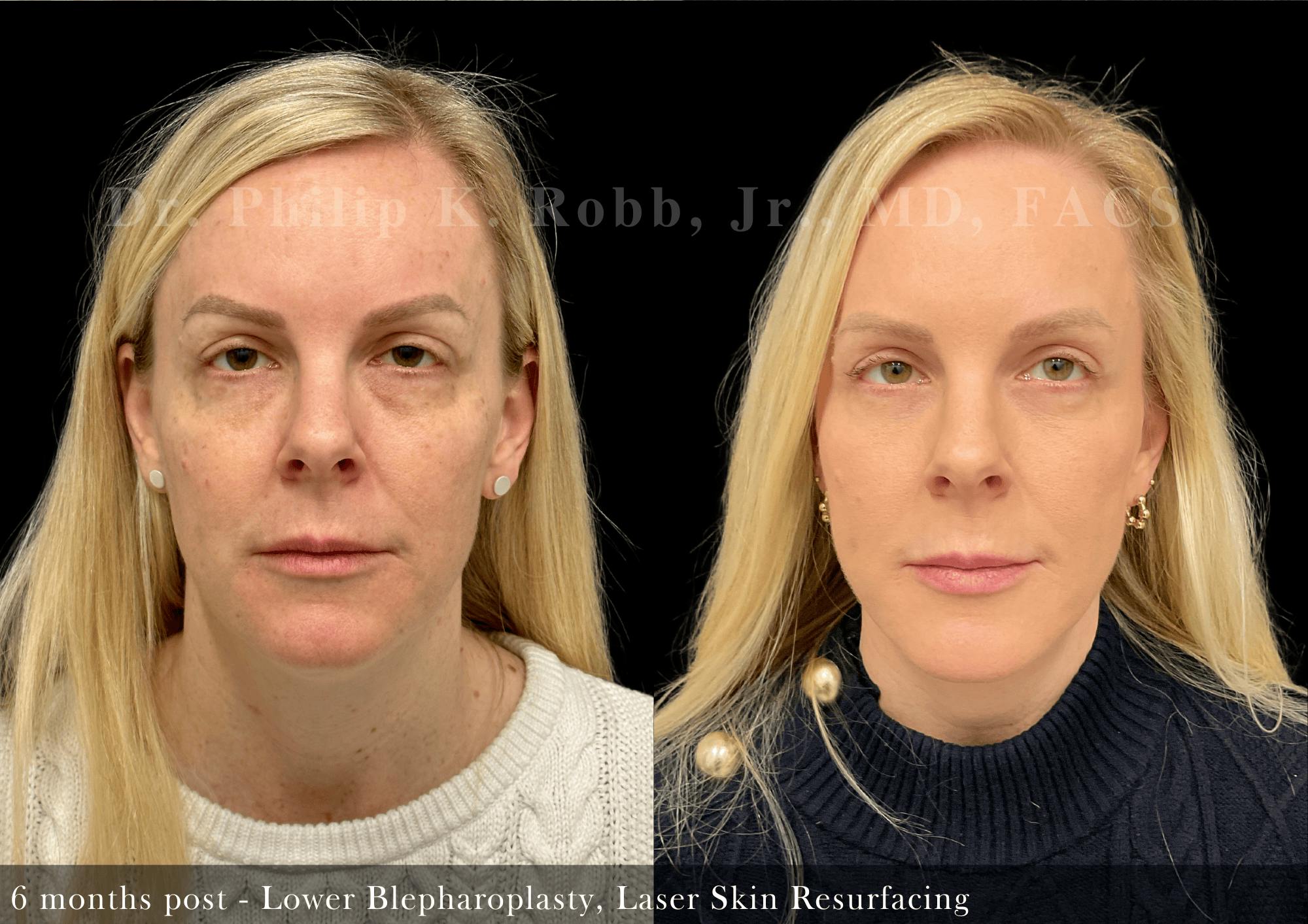 Lower Blepharoplasty Before & After Gallery - Patient 232066 - Image 2