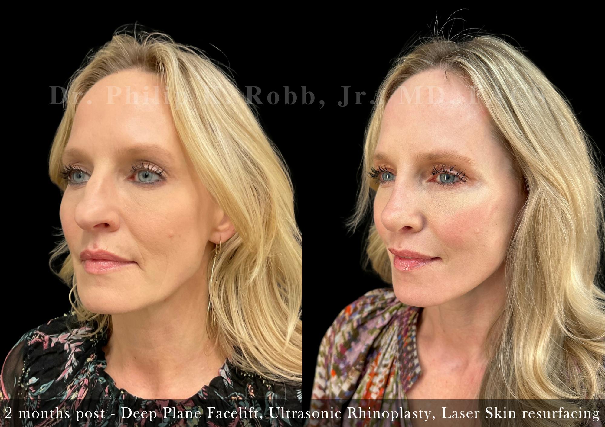 Facelift Before & After Gallery - Patient 710736 - Image 4