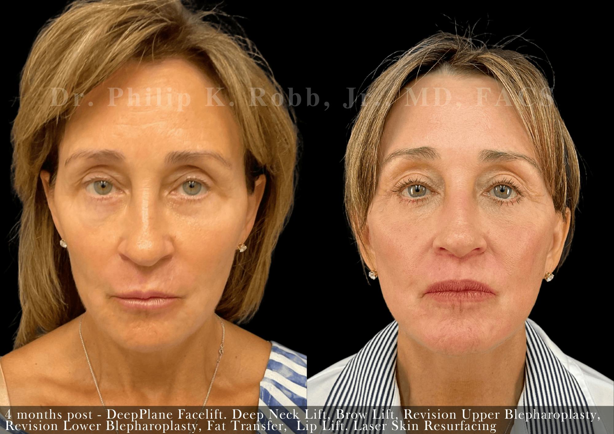 Lower Blepharoplasty Before & After Gallery - Patient 247284 - Image 1