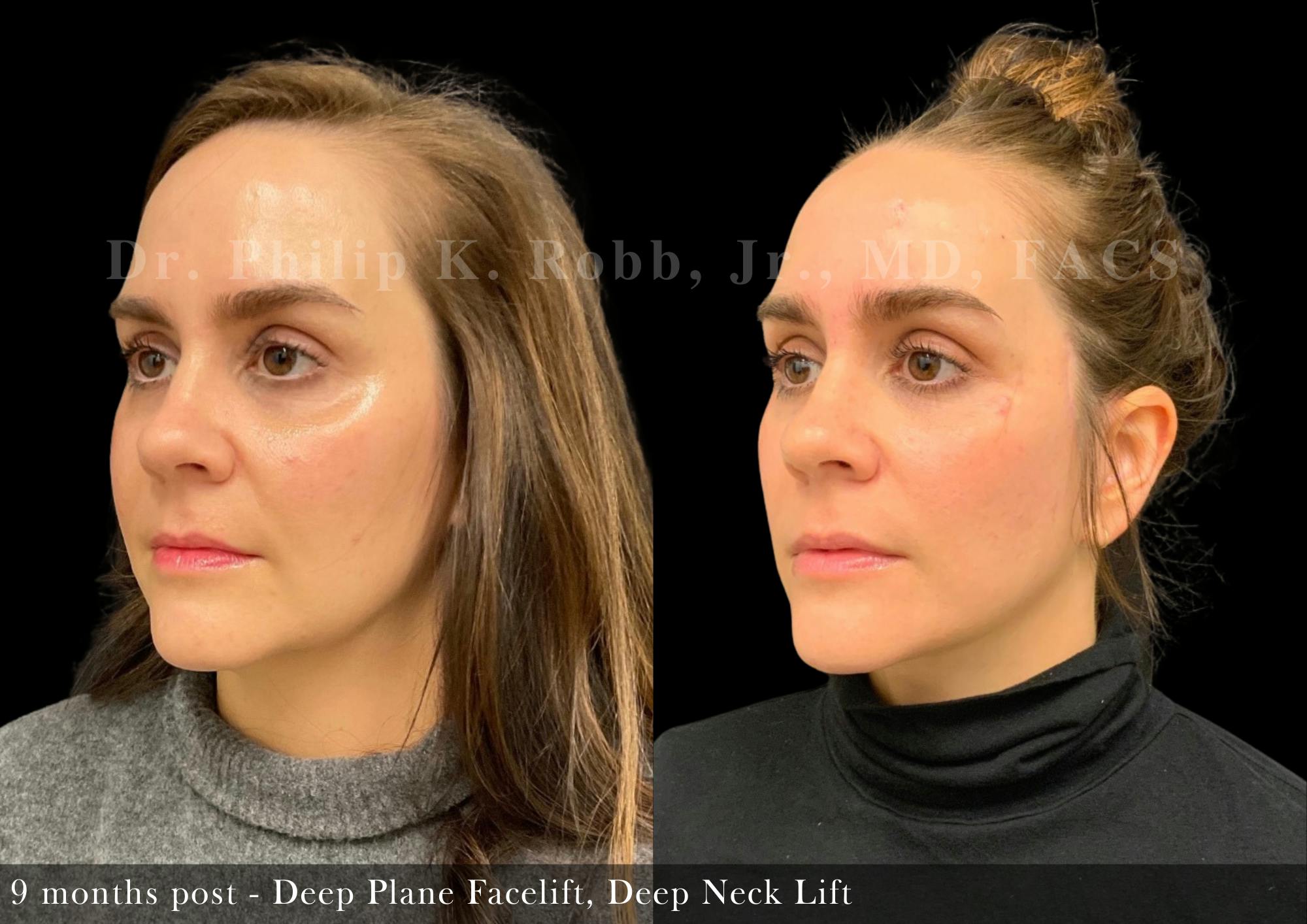 Neck Lift Before & After Gallery - Patient 325319 - Image 2