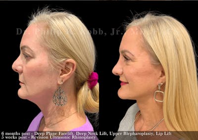 Lip Lift Before & After Gallery - Patient 149412 - Image 1