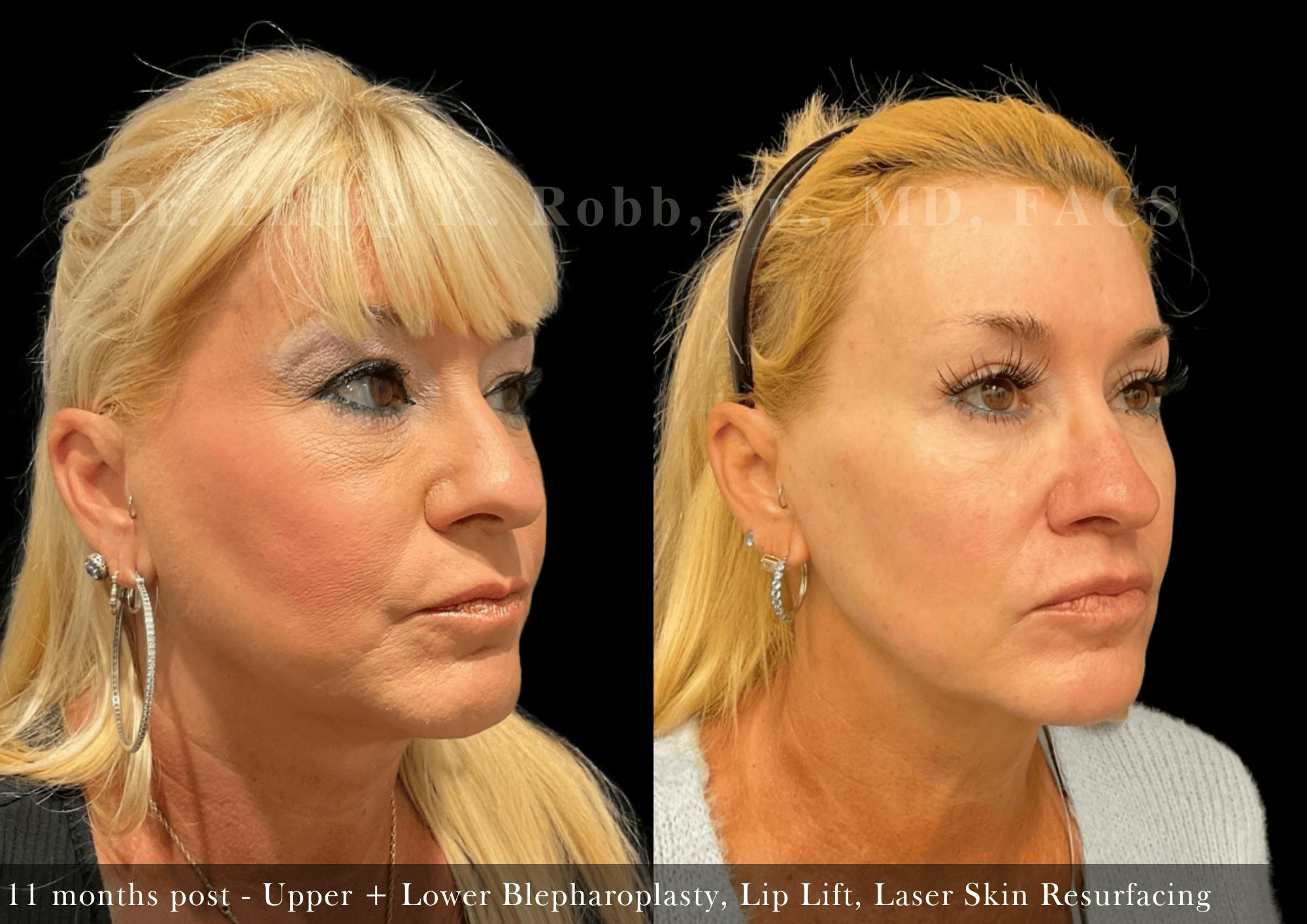 Upper Blepharoplasty Before & After Gallery - Patient 404657 - Image 3
