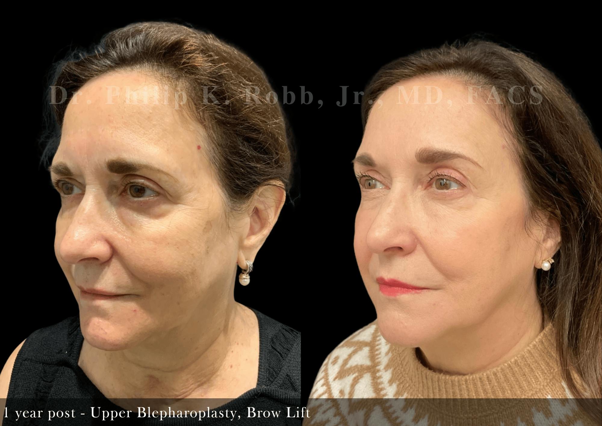 Upper Blepharoplasty Before & After Gallery - Patient 395618 - Image 2