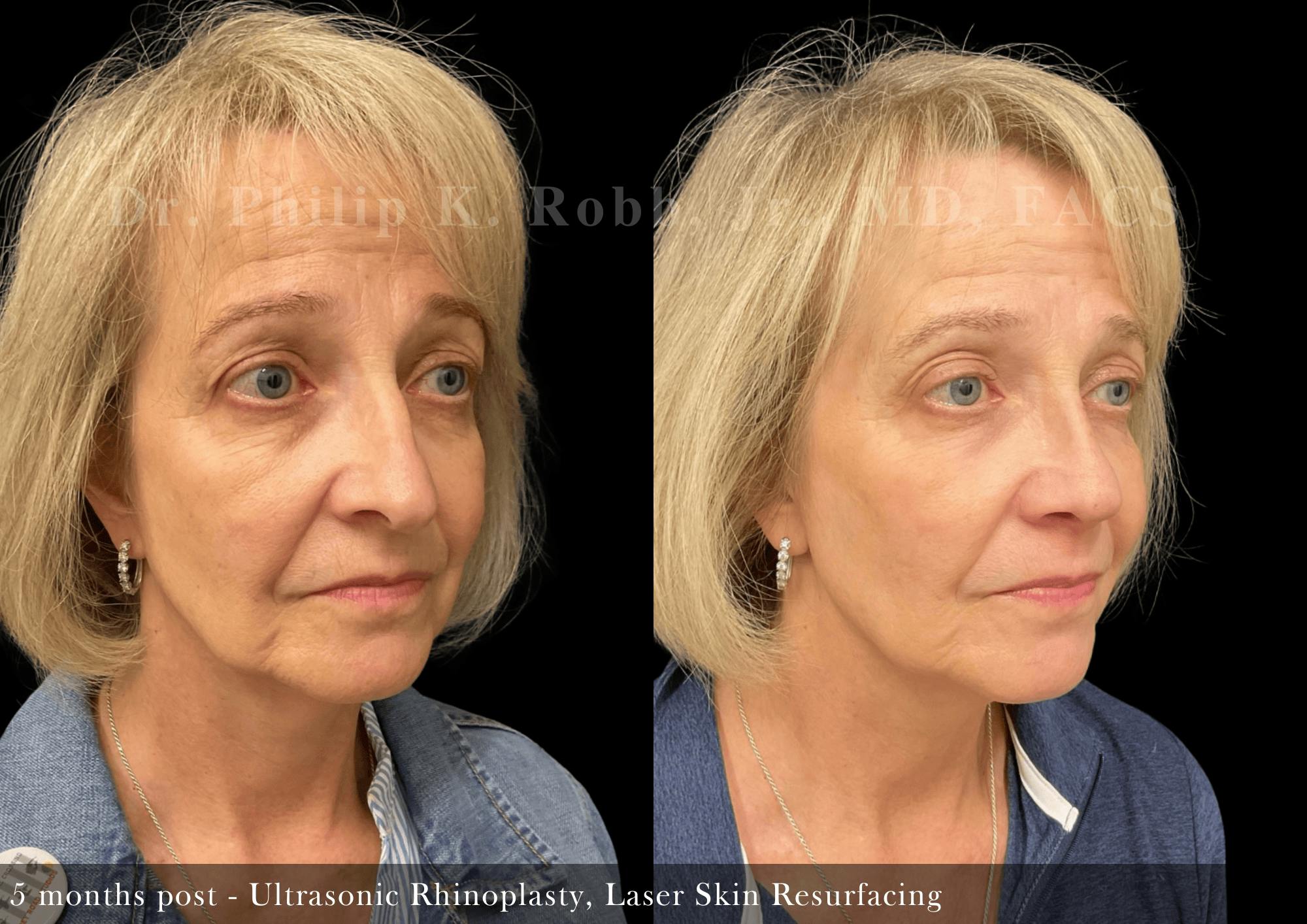 Laser Skin Resurfacing Before & After Gallery - Patient 183537 - Image 2