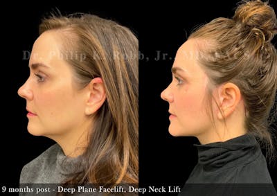 Neck Lift Before & After Gallery - Patient 325319 - Image 1