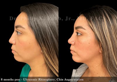 Chin Augmentation Before & After Gallery - Patient 179277 - Image 1