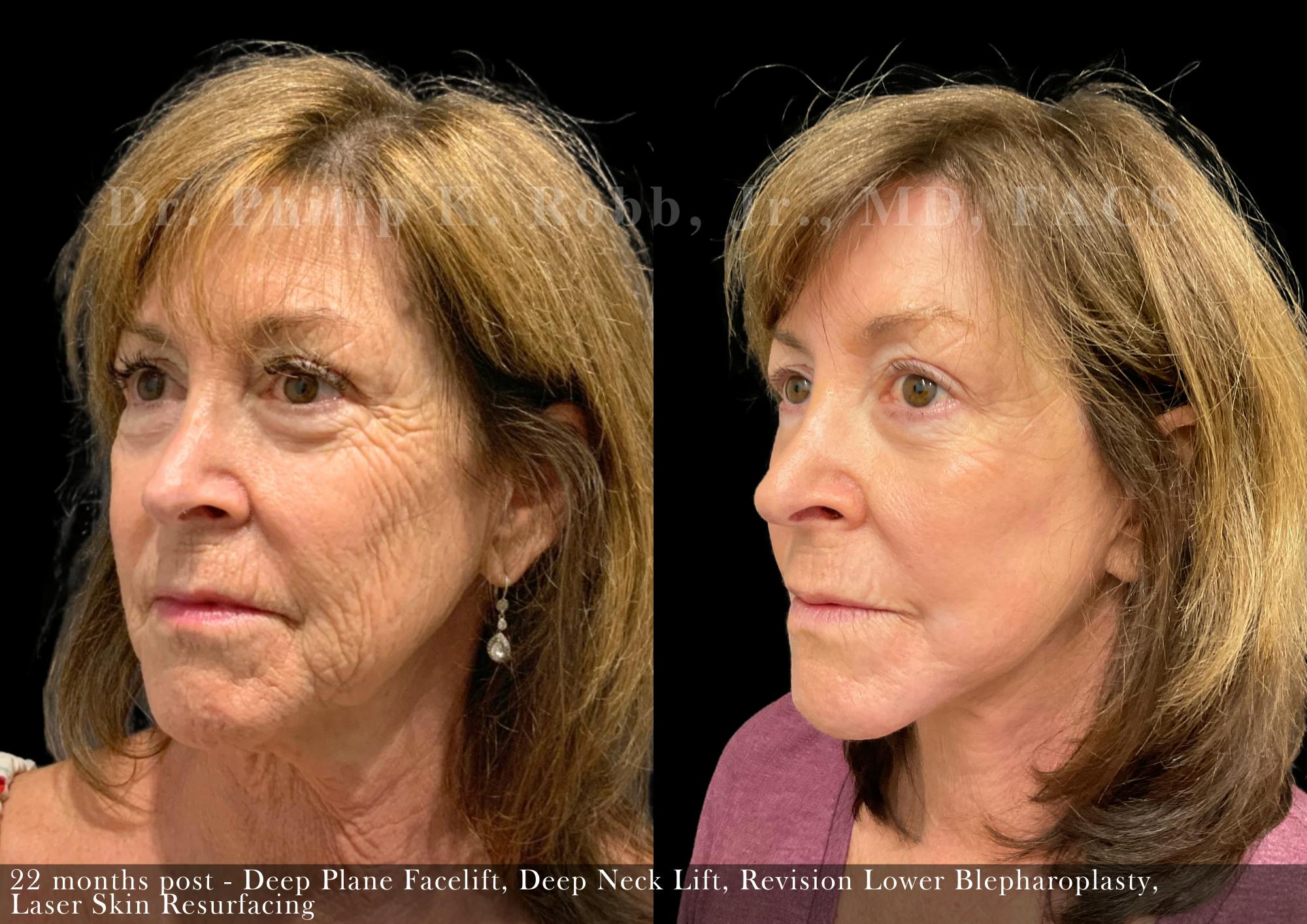 Facelift Before & After Gallery - Patient 143539 - Image 1