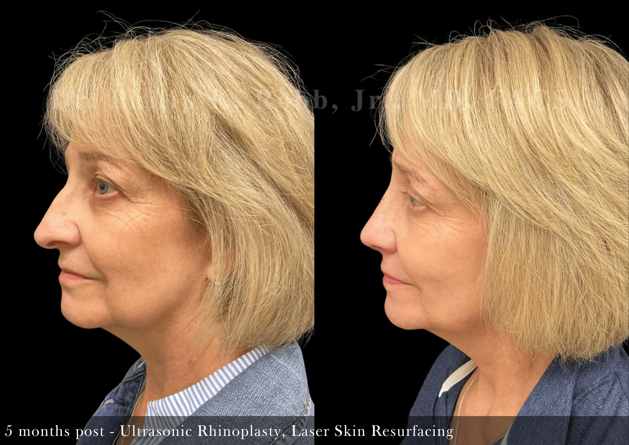 Laser Skin Resurfacing Before & After Gallery - Patient 183537 - Image 4