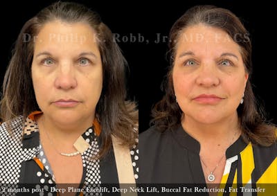 Facial Implants & Fat Transfer Before & After Gallery - Patient 338601 - Image 1