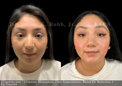 Chin Augmentation Before & After Gallery - Patient 582751 - Image 1