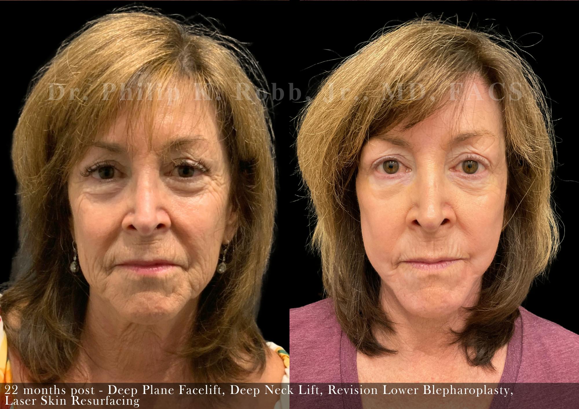 Facelift Before & After Gallery - Patient 143539 - Image 3
