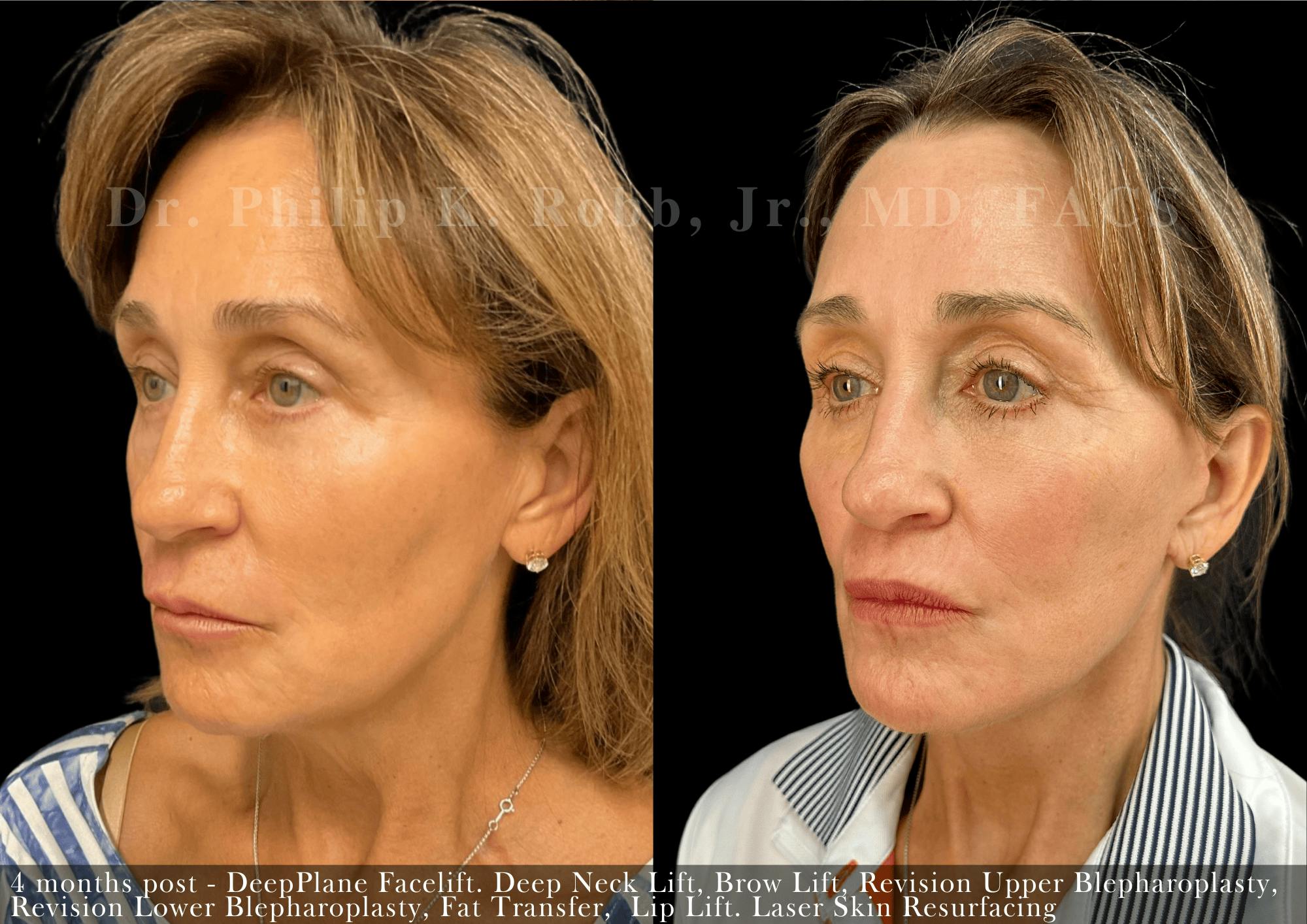 Lip Lift Before & After Gallery - Patient 390992 - Image 3