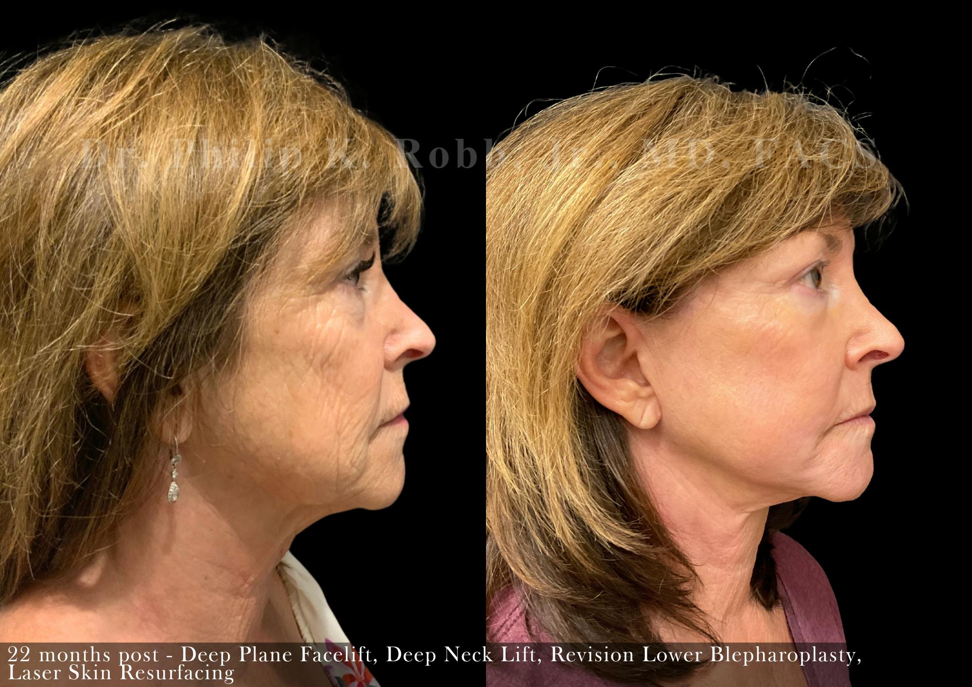 Facelift Before & After Gallery - Patient 143539 - Image 4