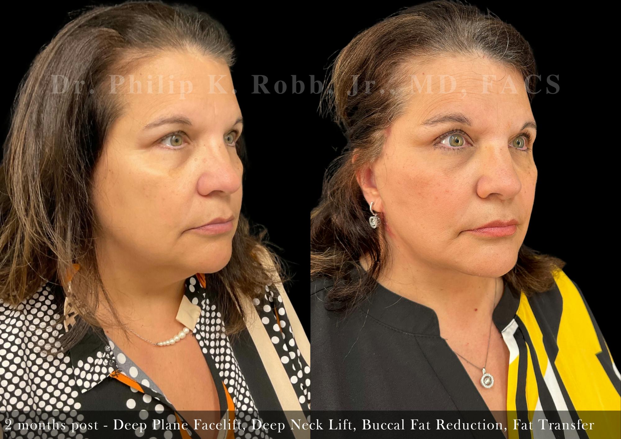 Facial Implants & Fat Transfer Before & After Gallery - Patient 338601 - Image 2