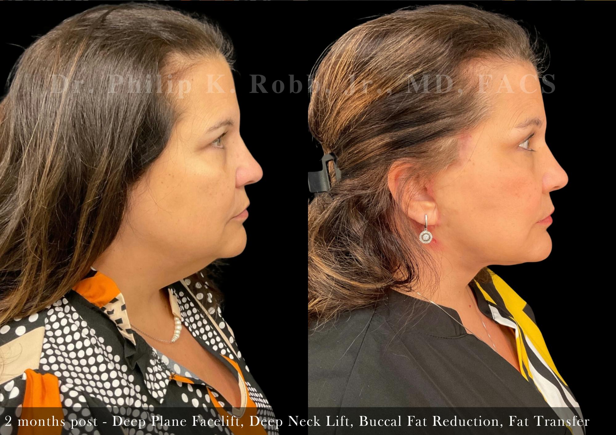 Facial Implants & Fat Transfer Before & After Gallery - Patient 338601 - Image 3