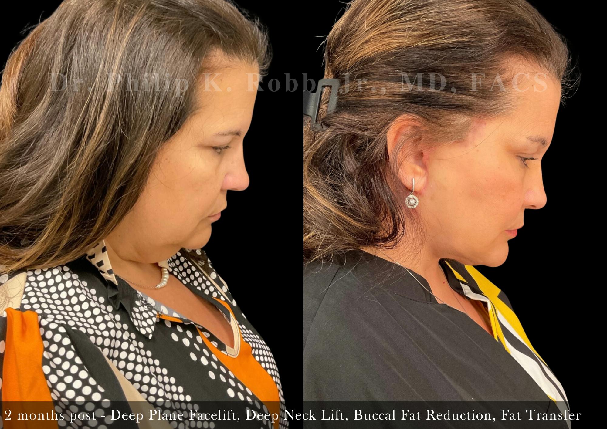 Facial Implants & Fat Transfer Before & After Gallery - Patient 338601 - Image 4