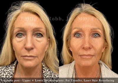 Lower Blepharoplasty Before & After Gallery - Patient 348855 - Image 1