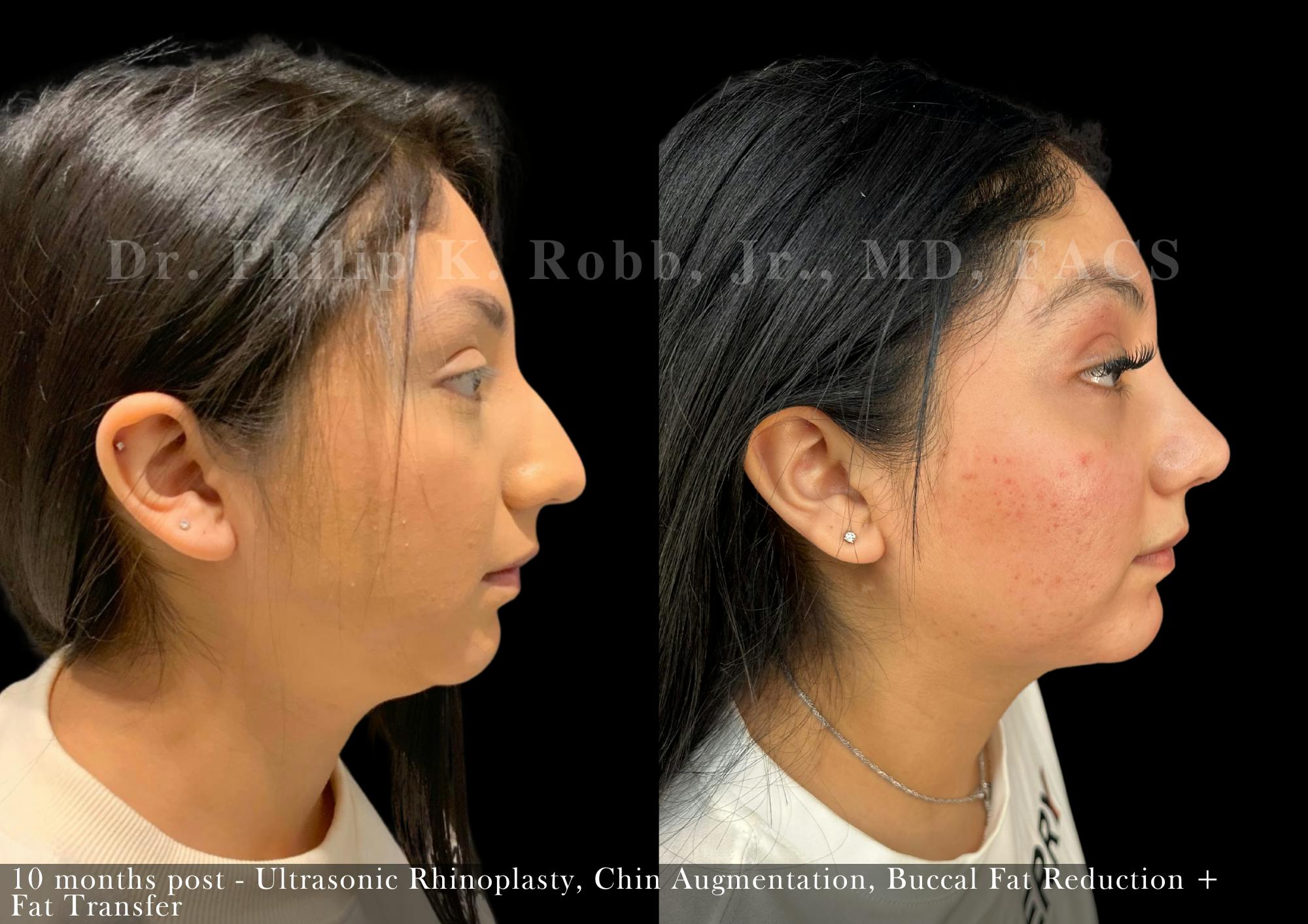Chin Augmentation Before & After Gallery - Patient 582751 - Image 5