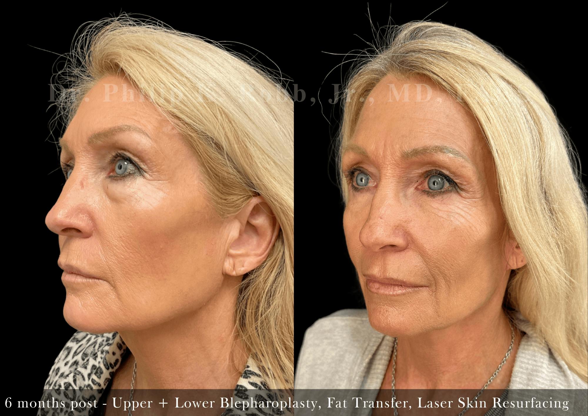Lower Blepharoplasty Before & After Gallery - Patient 348855 - Image 2