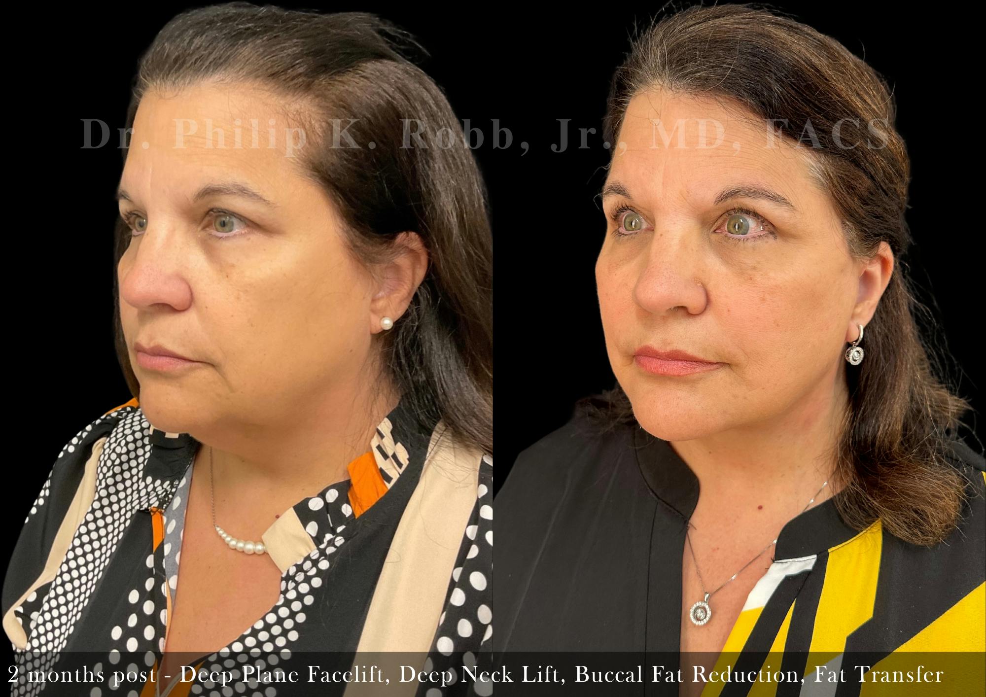 Facial Implants & Fat Transfer Before & After Gallery - Patient 338601 - Image 5