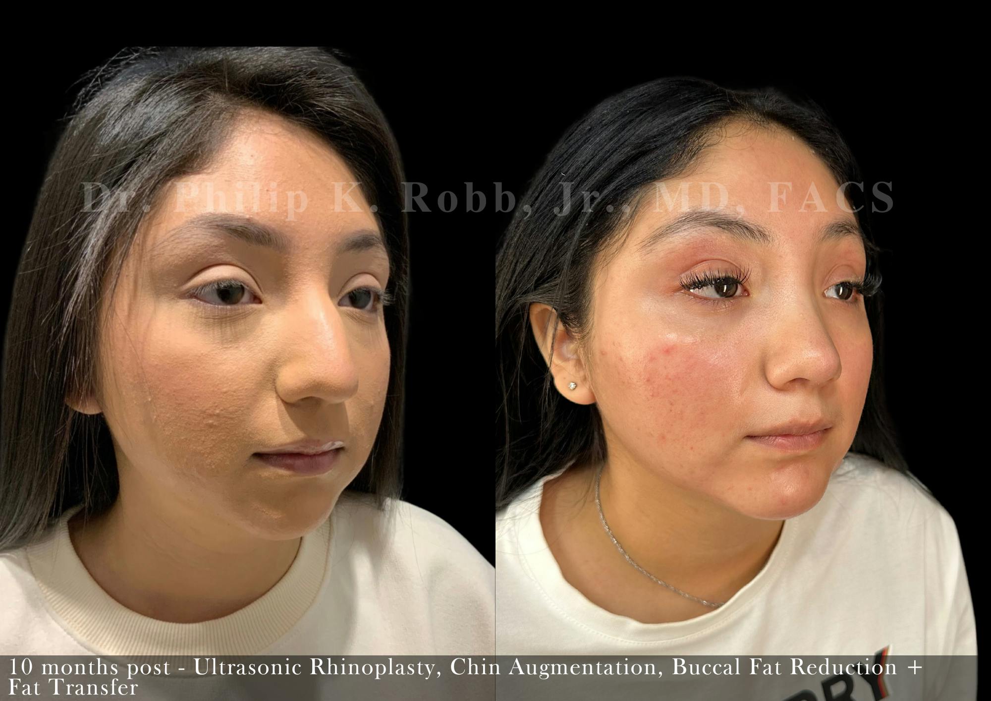 Fat Transfer Before & After Gallery - Patient 356307 - Image 4