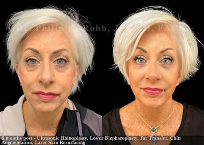 Chin Augmentation Before & After Gallery - Patient 281936 - Image 1