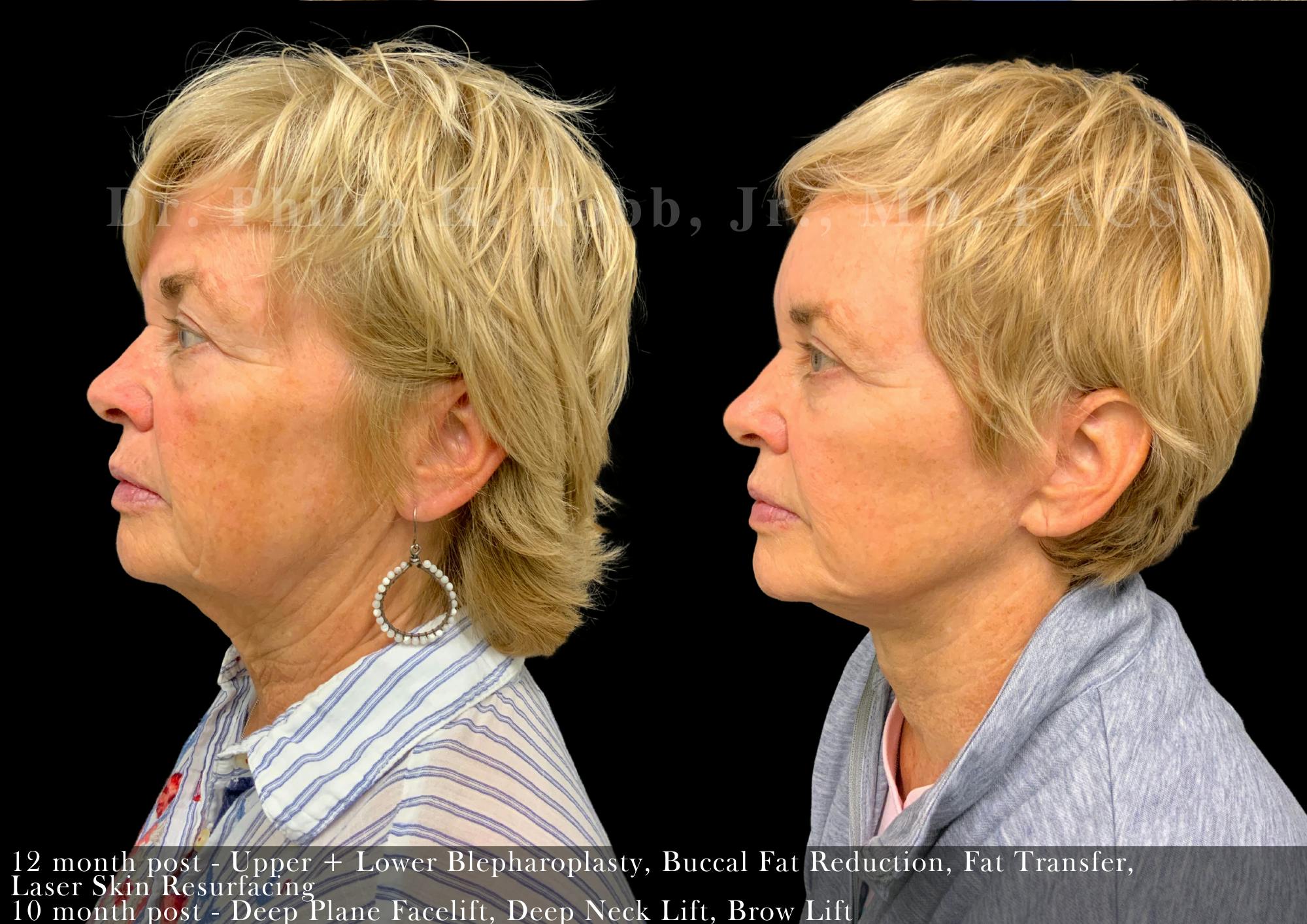 Brow Lift Before & After Gallery - Patient 598368 - Image 2