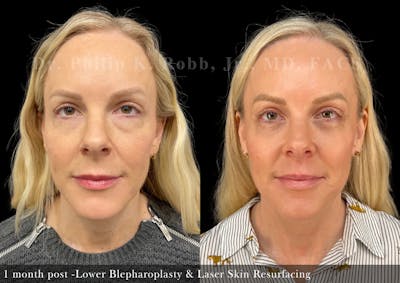 Lower Blepharoplasty Before & After Gallery - Patient 419061 - Image 1