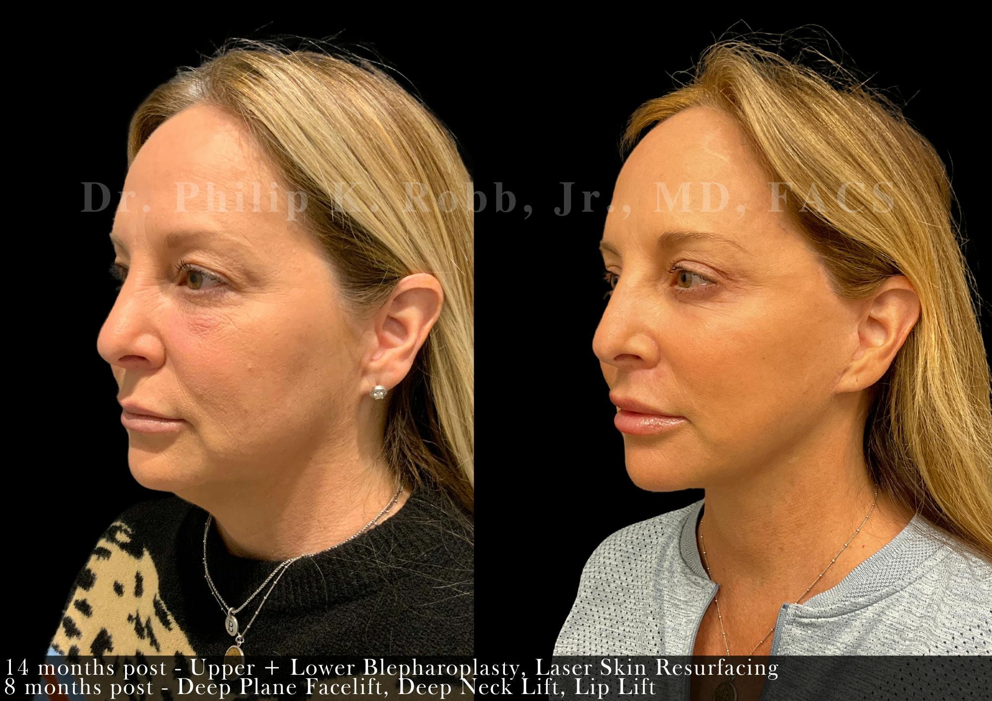 Facelift Before & After Gallery - Patient 242809 - Image 1