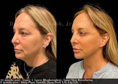 Facelift Before & After Gallery - Patient 242809 - Image 1